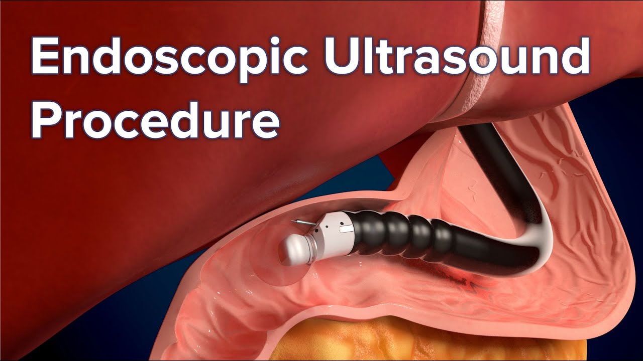 Endoscopic Ultrasound (EUS)- Purpose, Procedure and Results